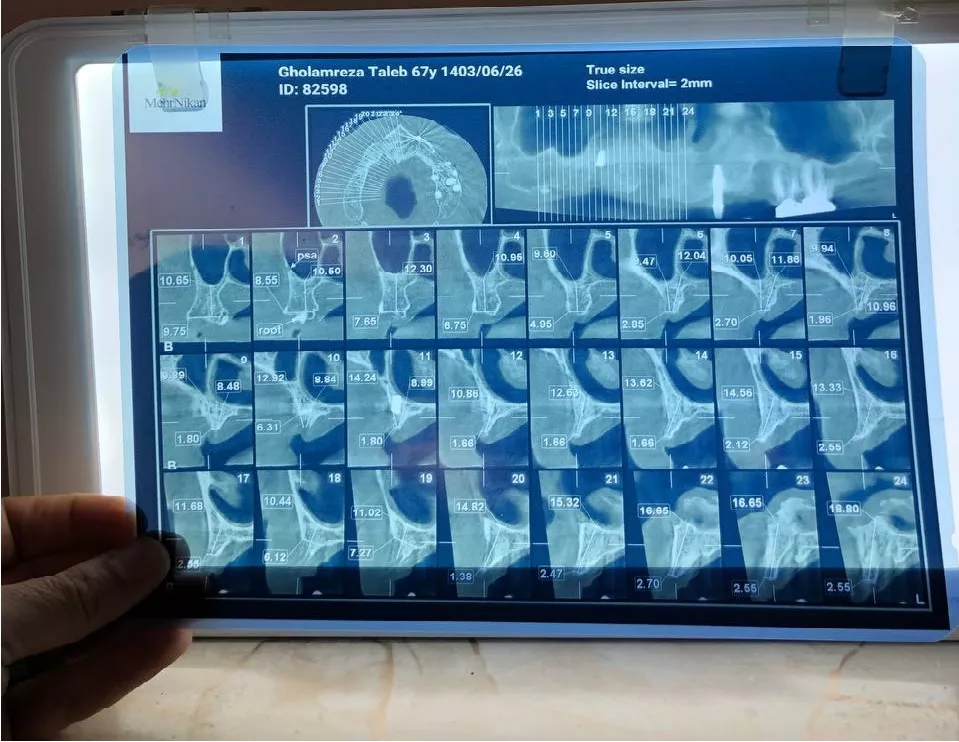 عکس CBCT ایمپلنت